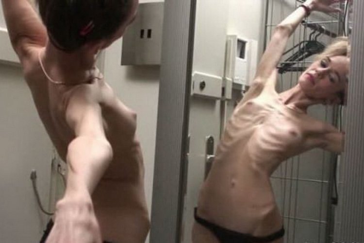 Naked guy with anorexia