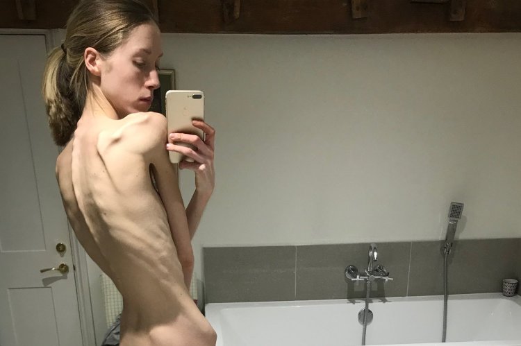 Women Naked anorexia