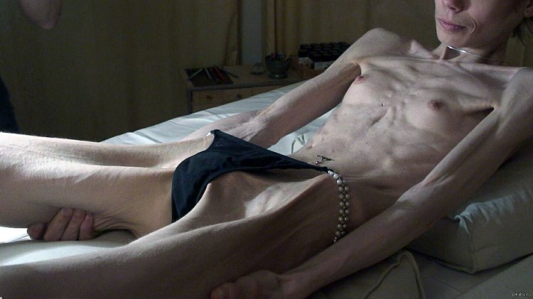 Naked guy with anorexia