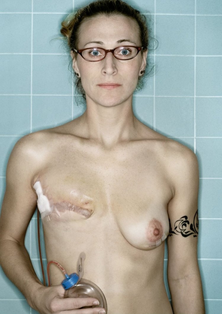 Operation Mastectomy