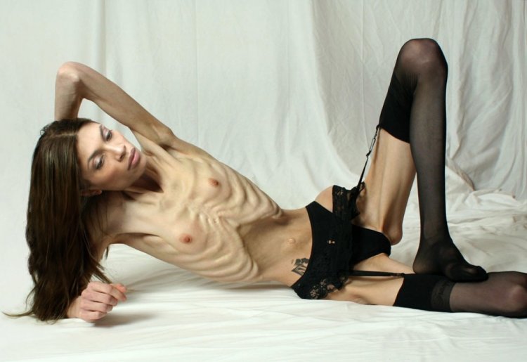 Girl with anorexia