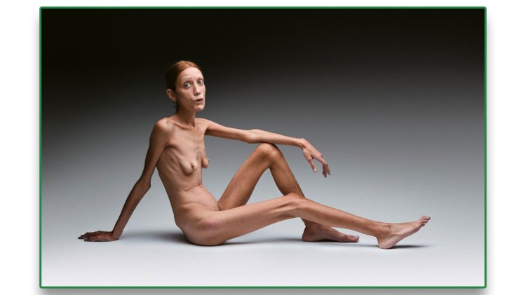 Girls with anorexia